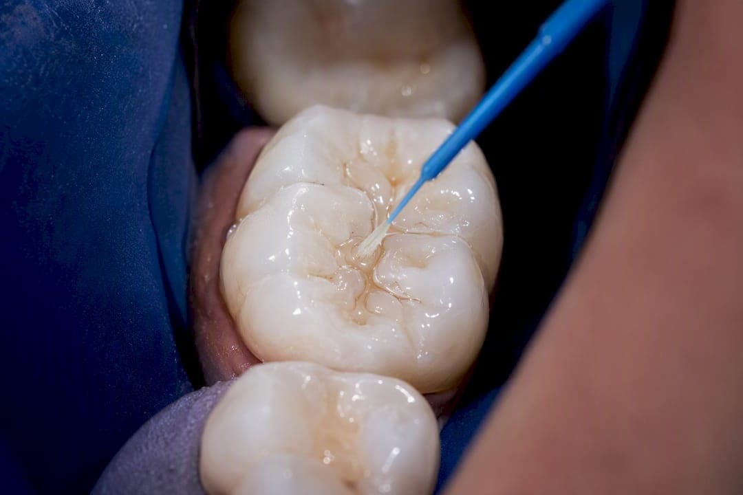 Prevent a $150–$600 Filling: When Adults Should Get Sealants