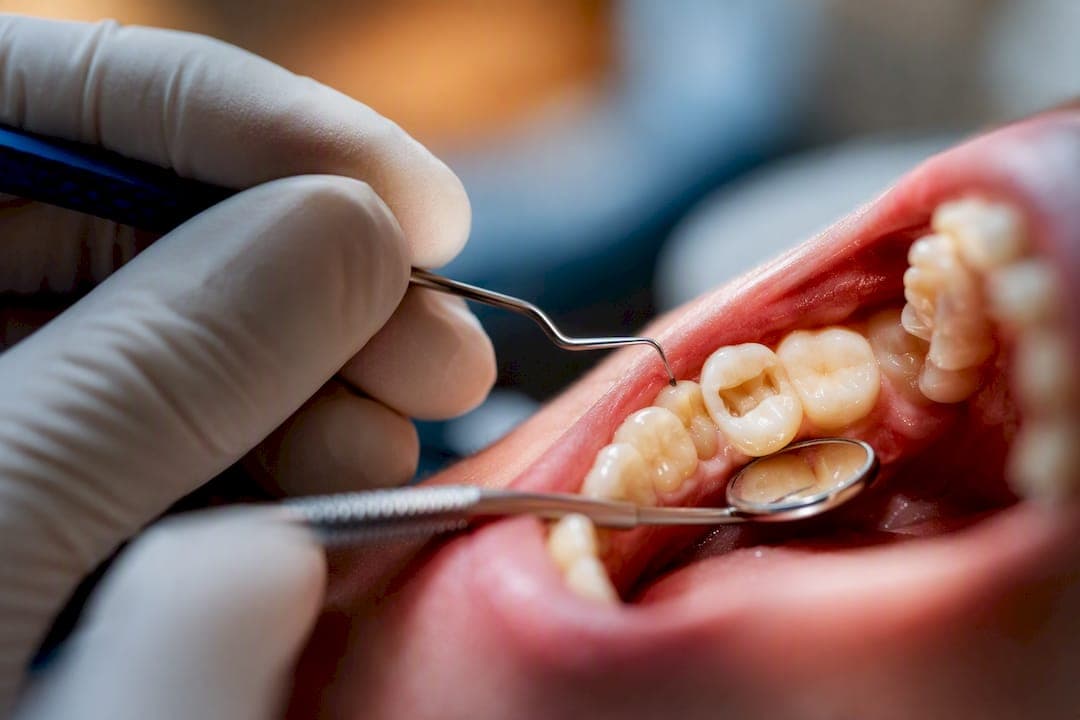 Lost a Filling? How Same Day Conservative Repair Saves Your Tooth