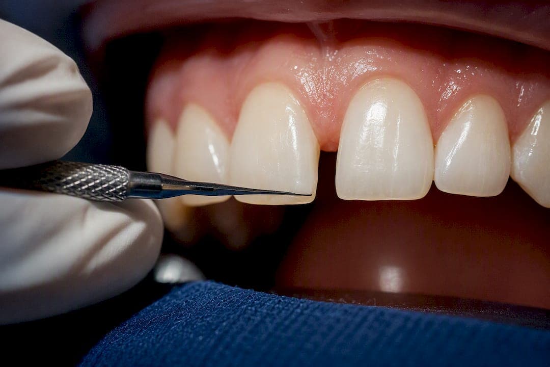 Move Teeth or Mask the Gap? How to Pick Diastema Closure Options in DC
